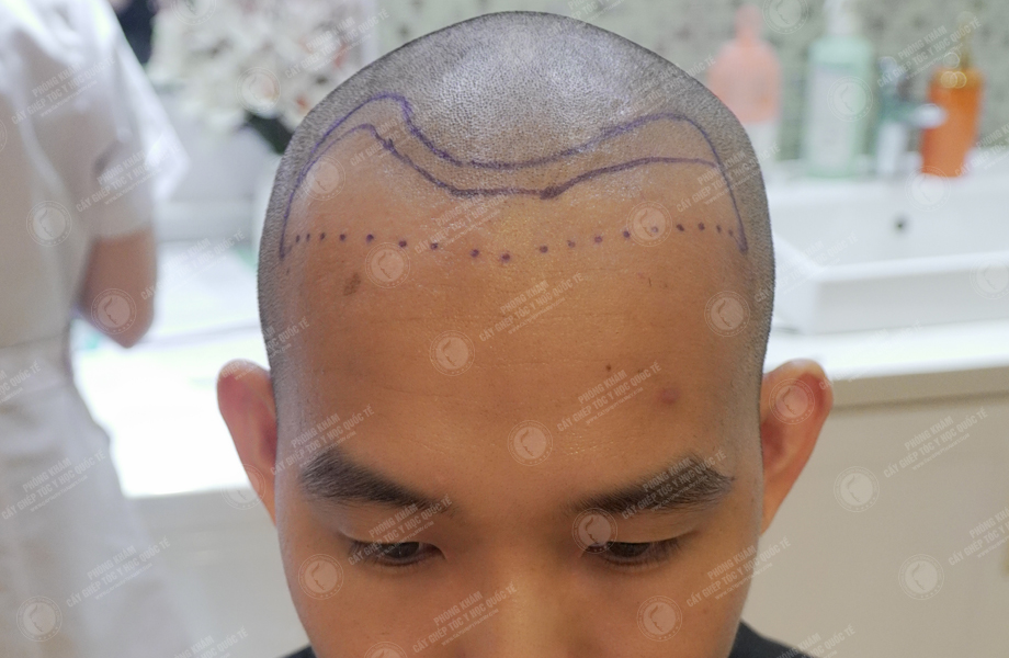 Lê Bá Hiệp - Cấy tóc đường chữ M 2