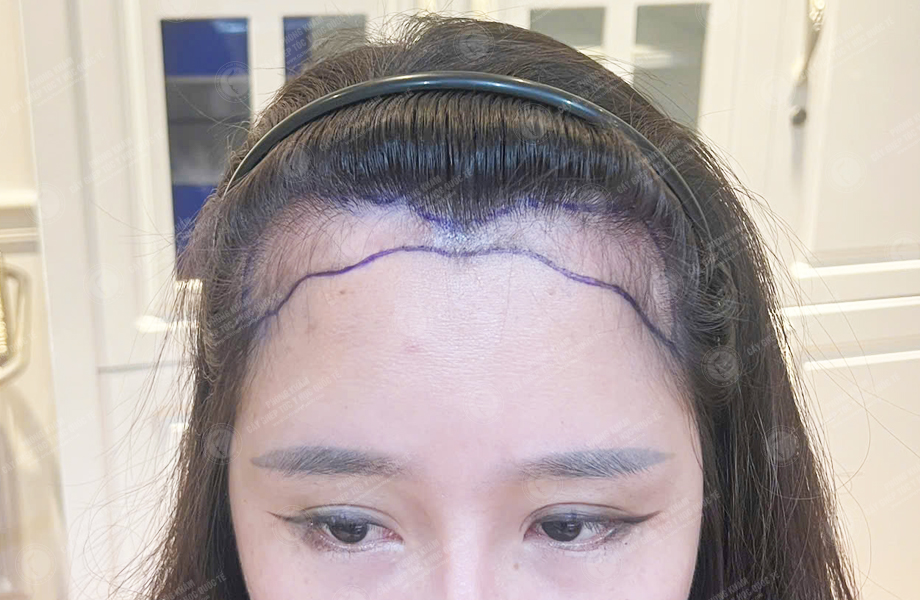 Hoàng Thu Hoài - Cấy tóc đường chữ M 2
