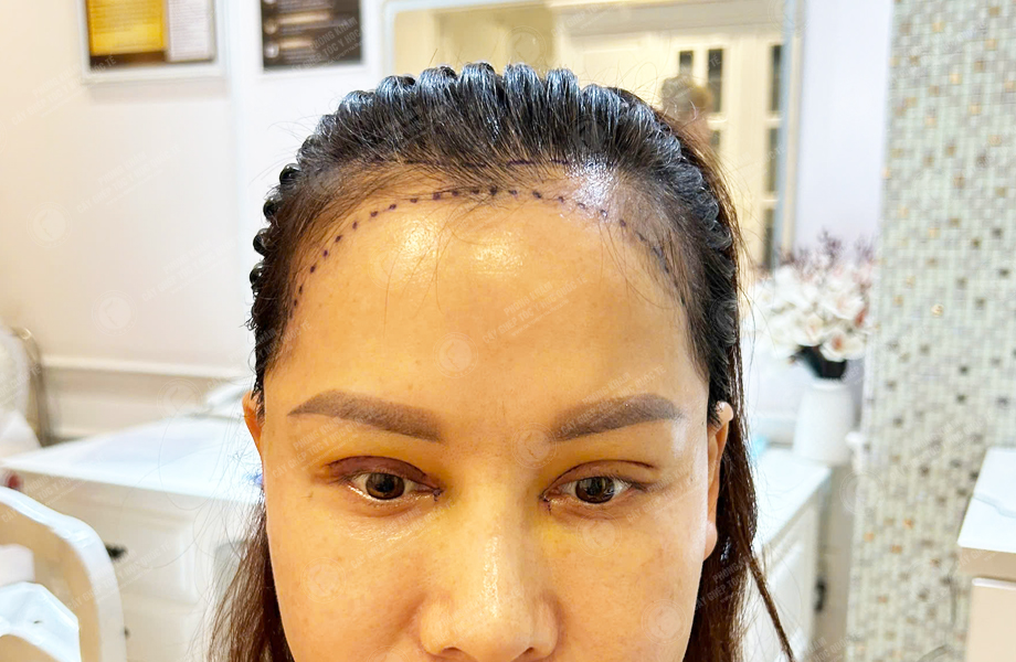 Ngô Thùy Dương - Cấy tóc đường chữ M 2