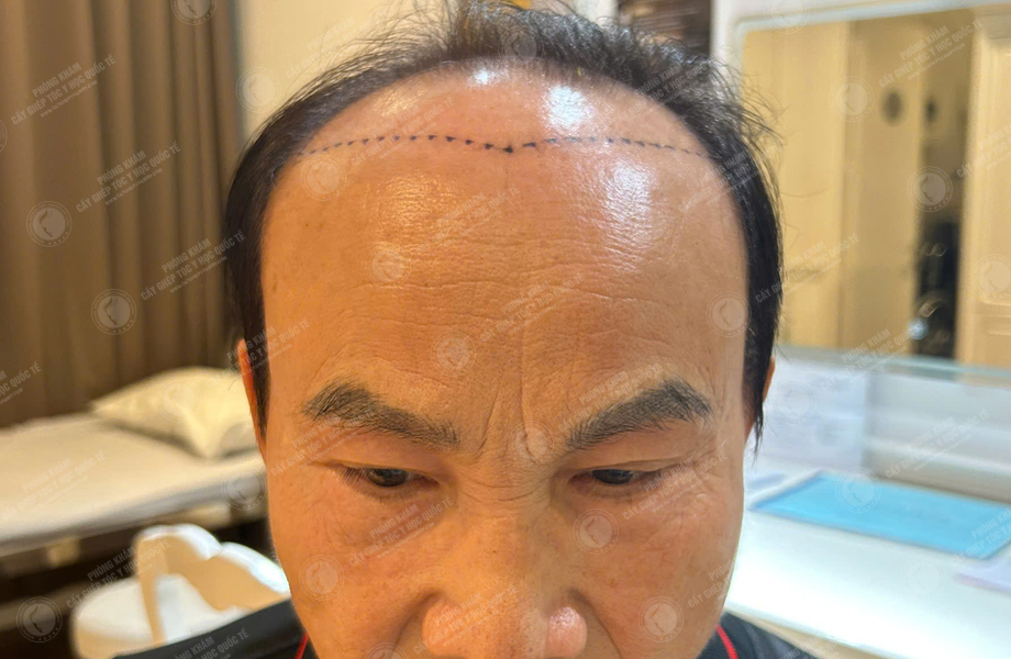 Nguyễn Hoàng Nam - Cấy tóc đường chữ M 2