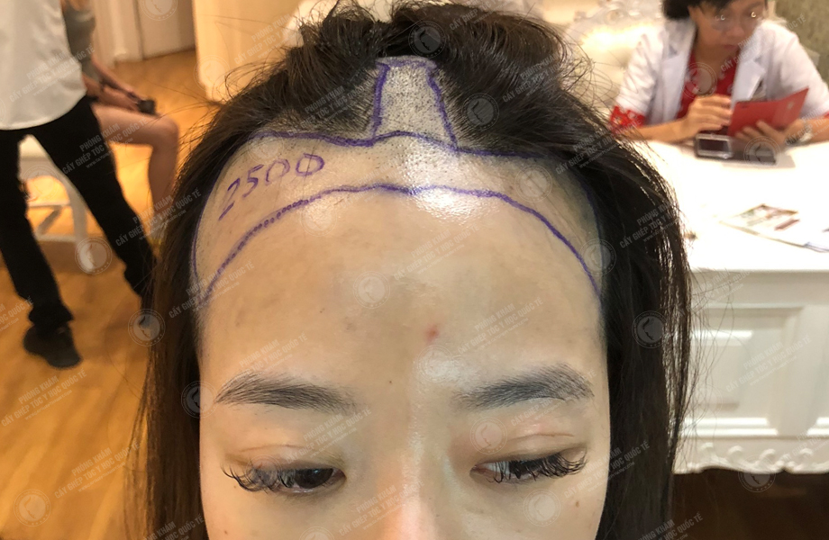 Phạm Thu Nguyệt - Cấy tóc đường chữ M 2