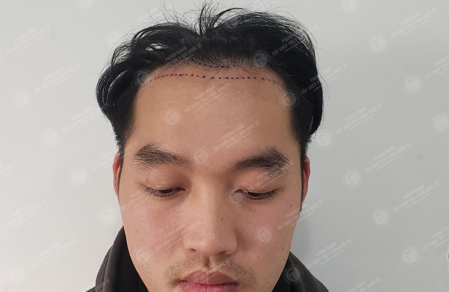 Phạm Trung Tuấn - Cấy tóc đường chữ M 2