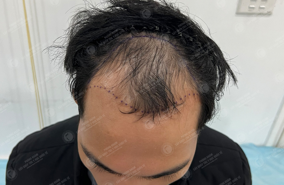 Trần Việt Dũng - Cấy tóc đường chữ M 2
