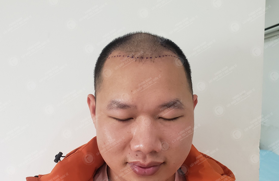 Trần Duy Tâm - Cấy tóc đường chữ M 2