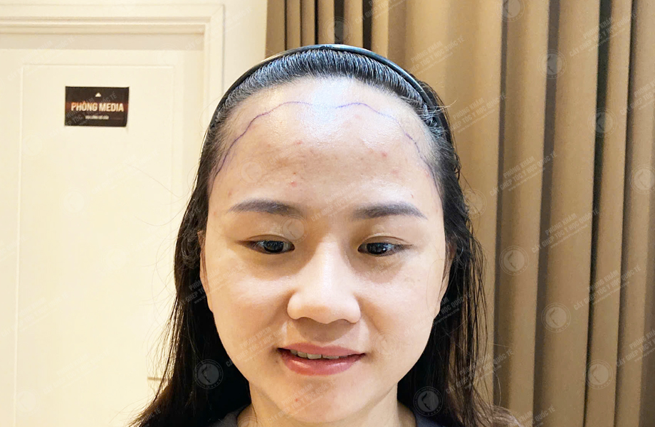 Nguyễn Thị Thúy Hằng - Cấy tóc đường chữ M 2