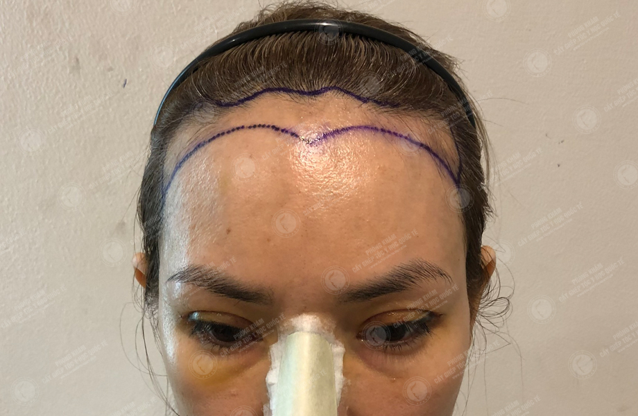 Lê Nhi - Cấy tóc đường chữ M 2