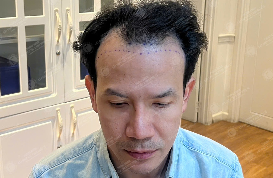 Nguyễn Hoàng Long - Cấy tóc đường chữ M 2