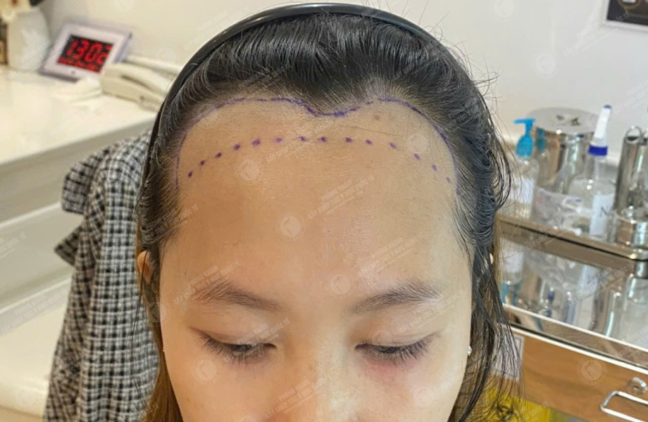 Phạm Thị Kim - Cấy tóc đường chữ M 2