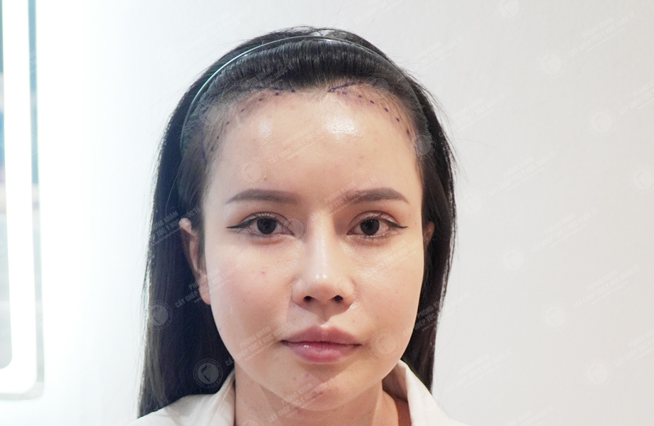 Nguyễn Thị Thảo - Cấy tóc đường chữ M 2