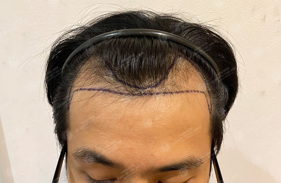 Hoàng Thanh Sơn - Cấy tóc đường chữ M 2