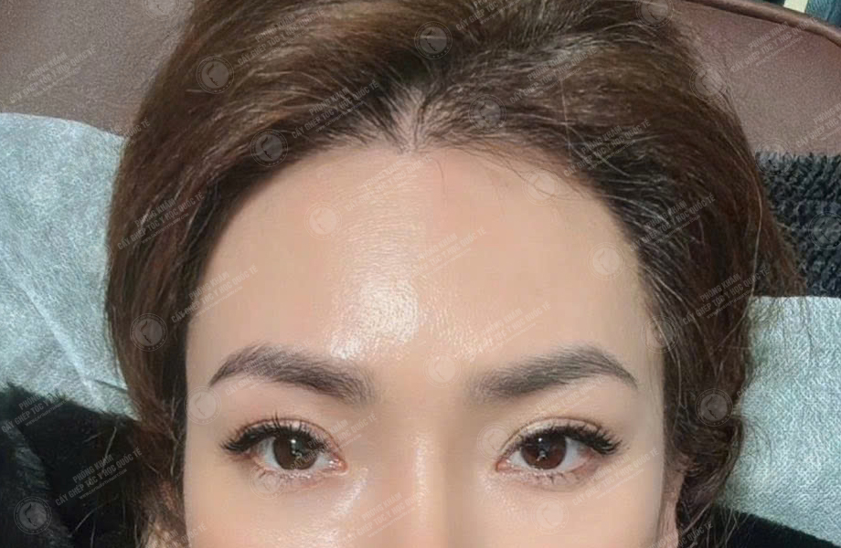 Lê Nhi - Cấy tóc đường chữ M 11