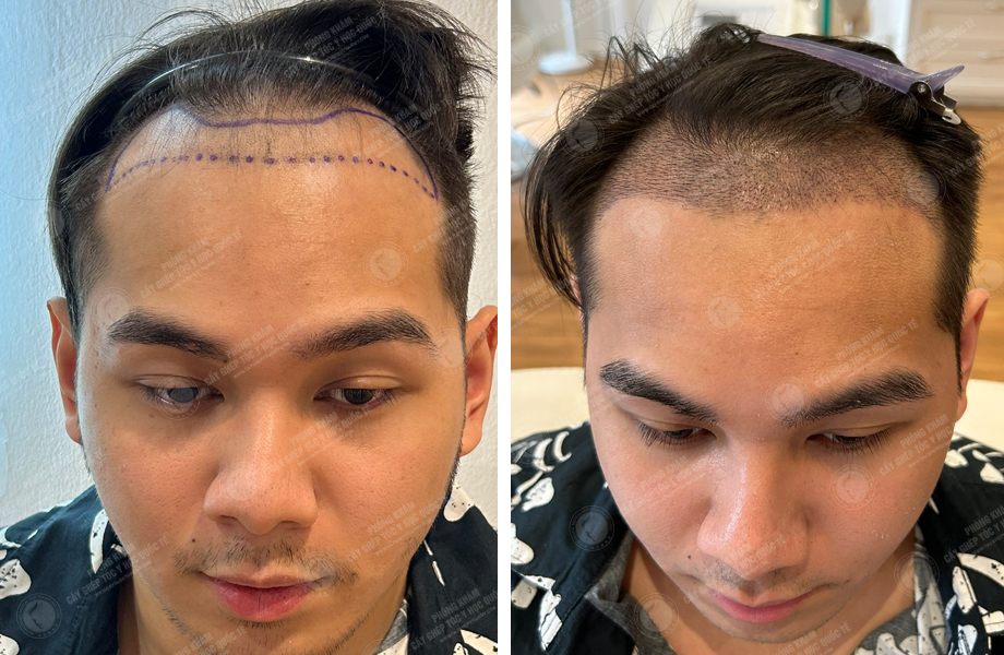  Phạm Trung Sơn - Cấy tóc đường chữ M 1