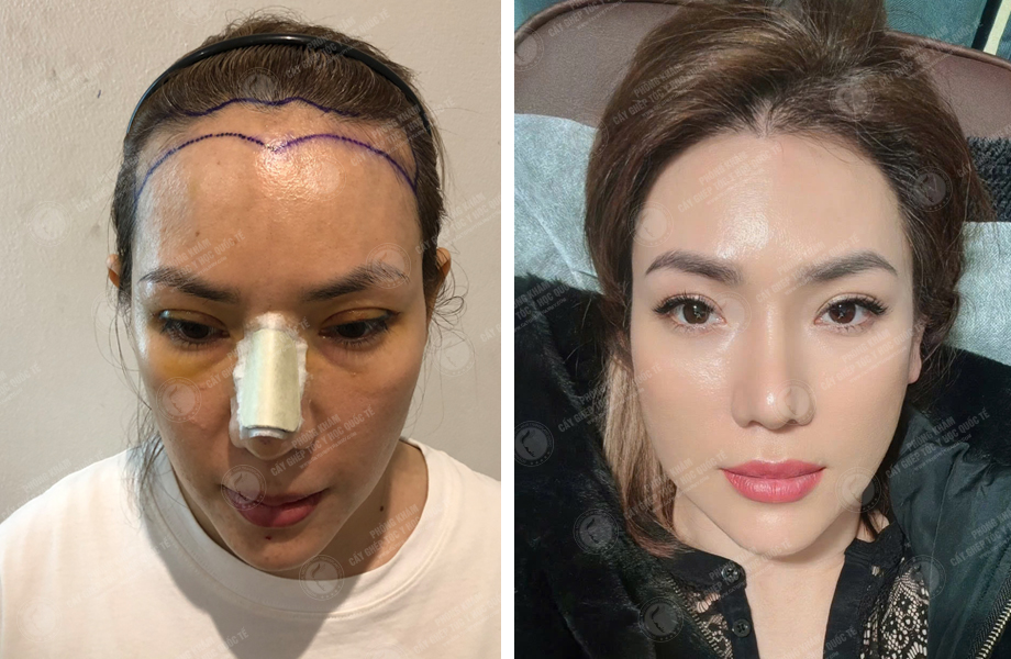  Lê Nhi - Cấy tóc đường chữ M 1