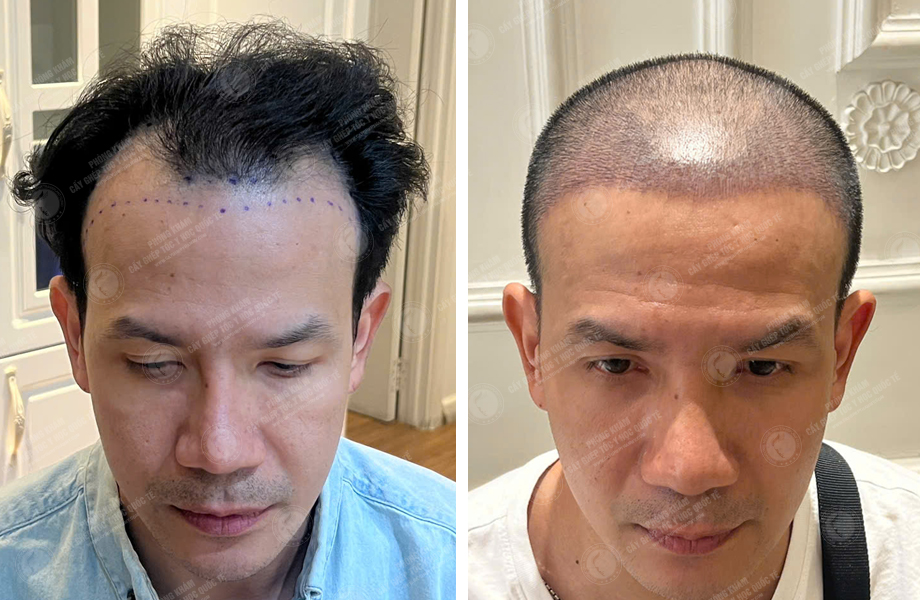  Nguyễn Hoàng Long - Cấy tóc tự thân 1