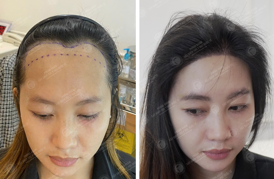  Phạm Thị Kim - Cấy tóc tự thân 1