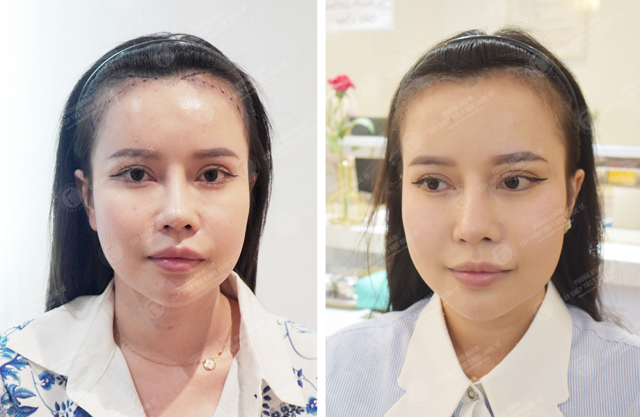  Nguyễn Thị Thảo - Cấy tóc tự thân 1