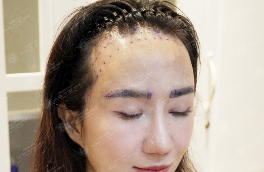 Nguyễn Thảo Phương - Cấy lông mày 3
