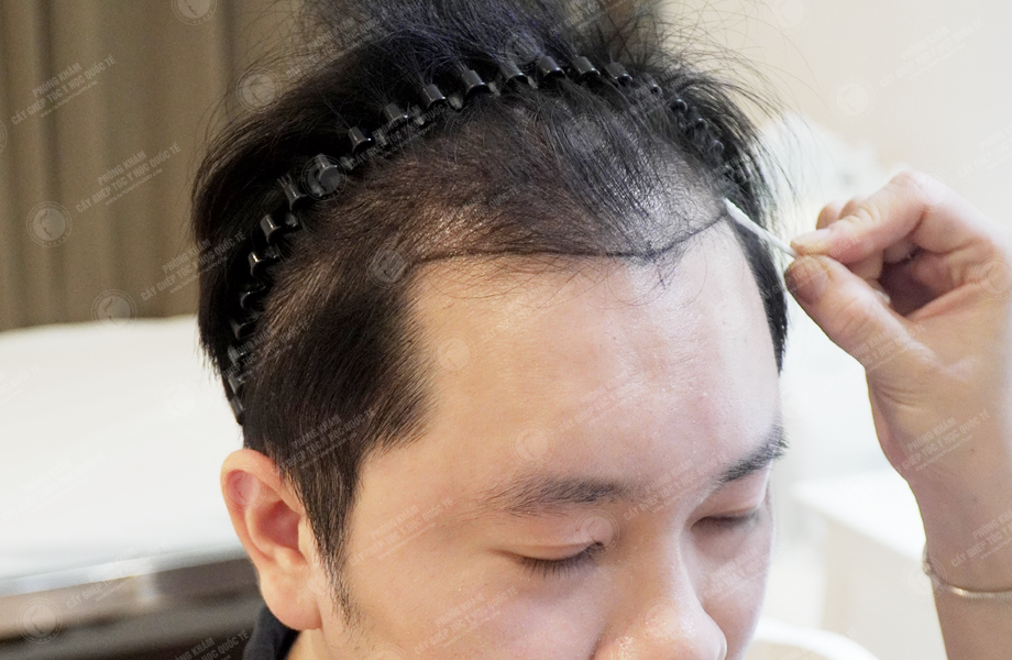 Nguyễn Thanh Tân - Cấy tóc đường chữ M 3