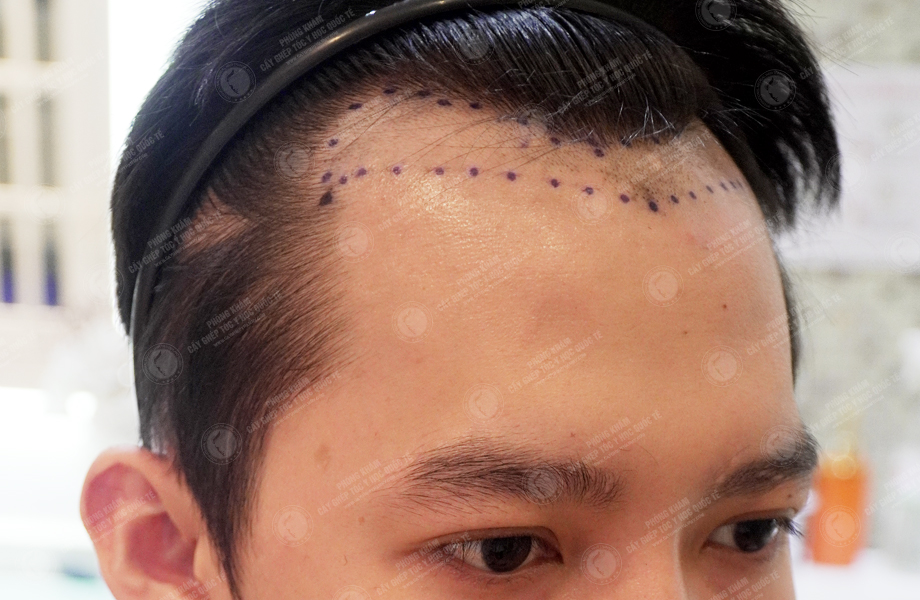 Nguyễn Thành Hưng - Cấy tóc đường chữ M 3