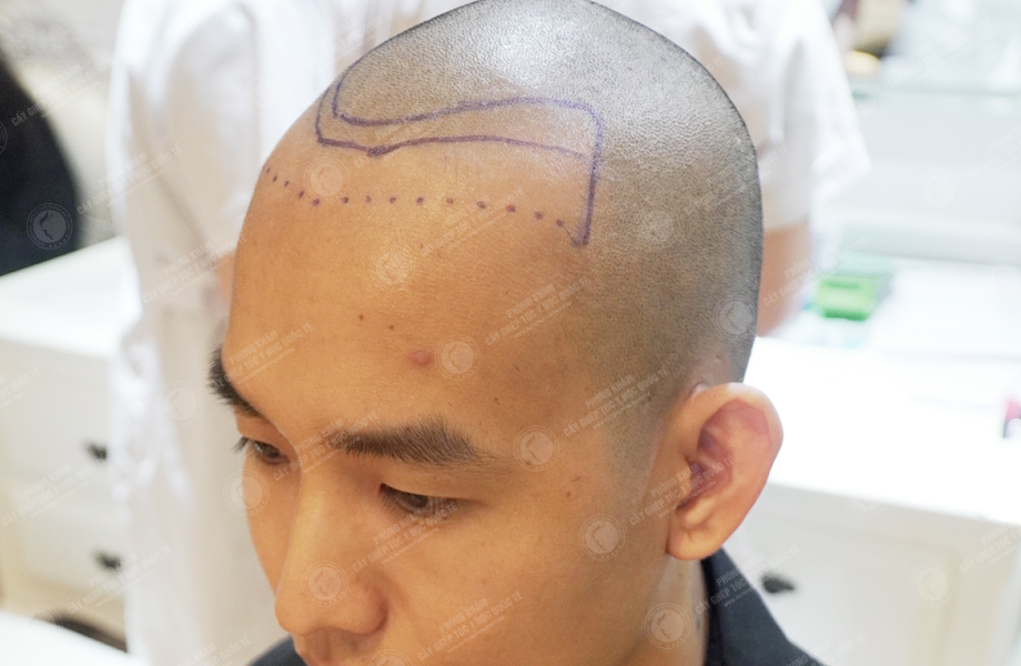 Lê Bá Hiệp - Cấy tóc đường chữ M 3