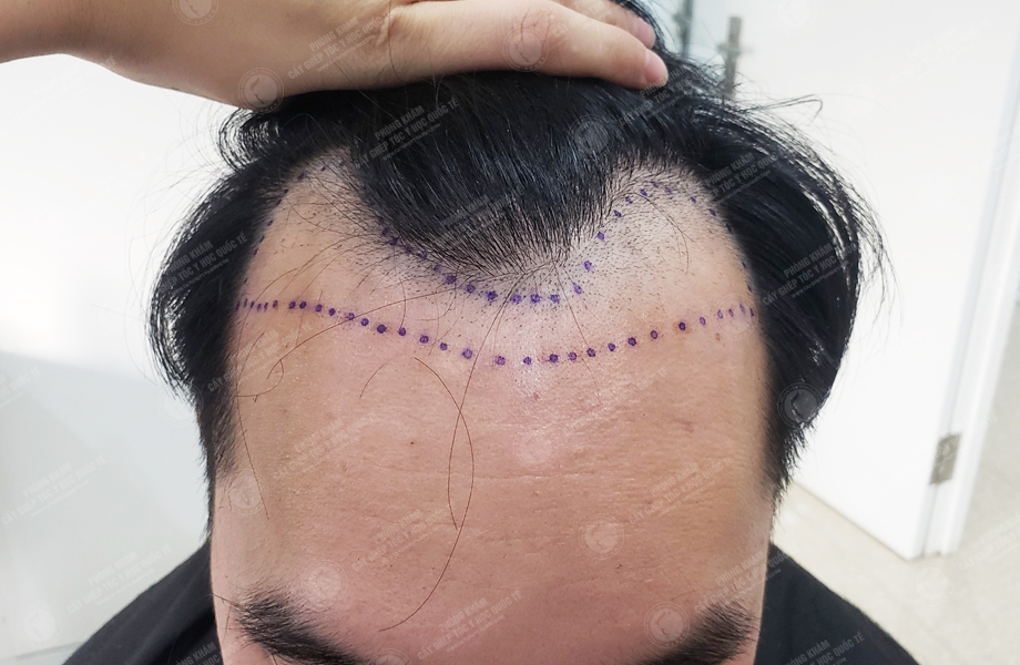 Phạm Trung Tuấn - Cấy tóc đường chữ M 3