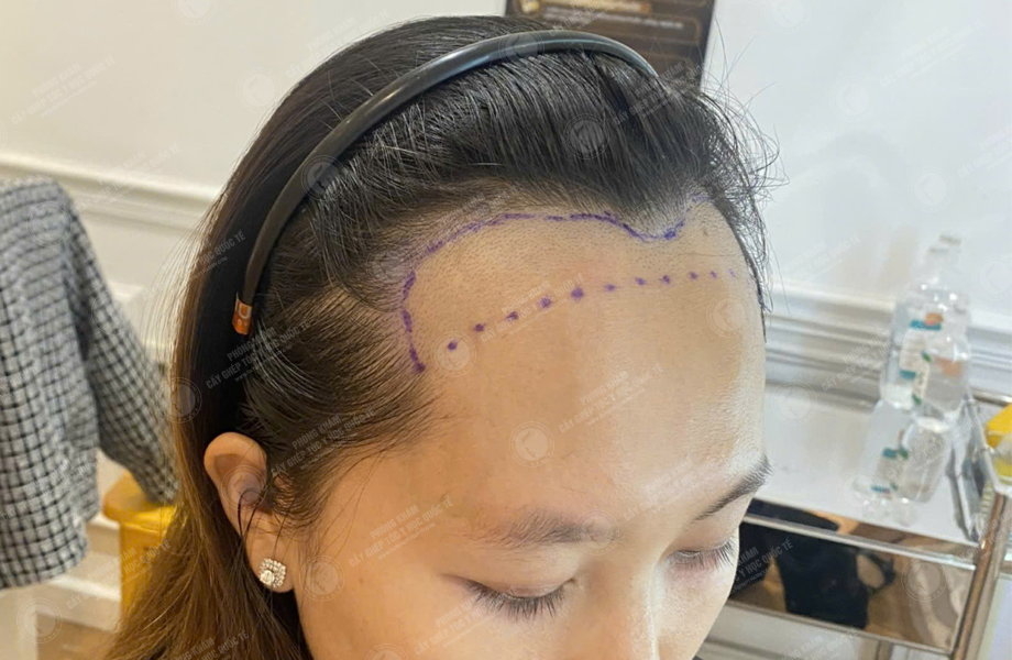 Phạm Thị Kim - Cấy tóc đường chữ M 3