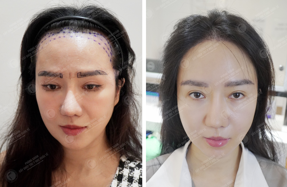  Nguyễn Thảo Phương - Cấy tóc tự thân 1