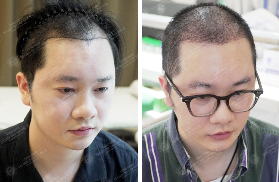 Nguyễn Thanh Tân - Cấy tóc tự thân 1
