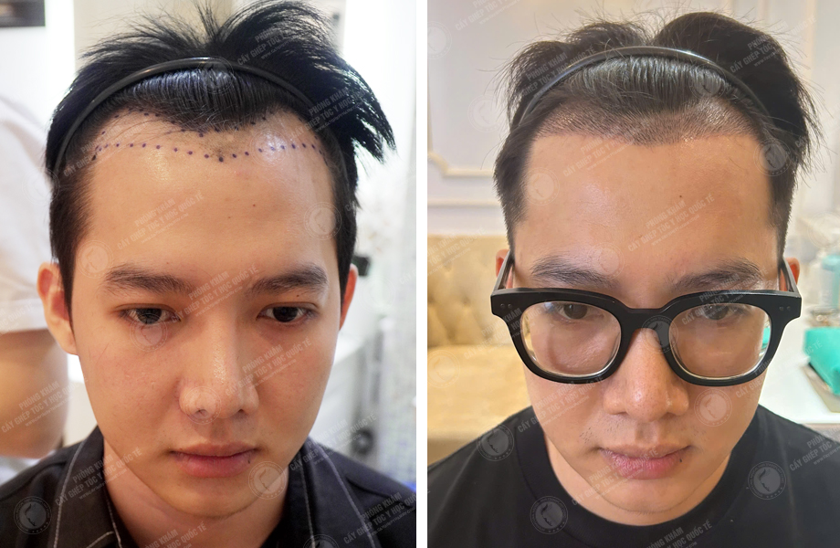  Nguyễn Thành Hưng - Cấy tóc đường chữ M 1