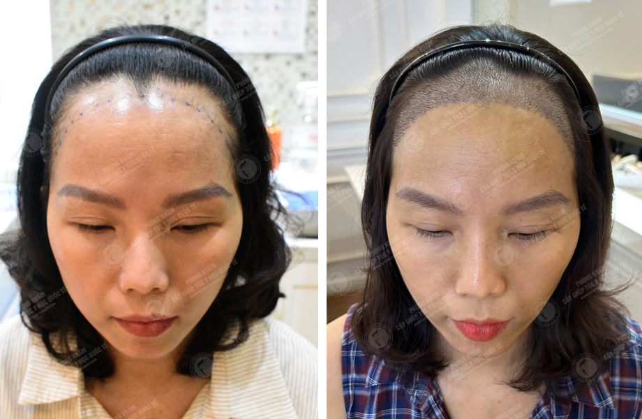  Phan Thị Tuyết - Cấy tóc đường chữ M 1