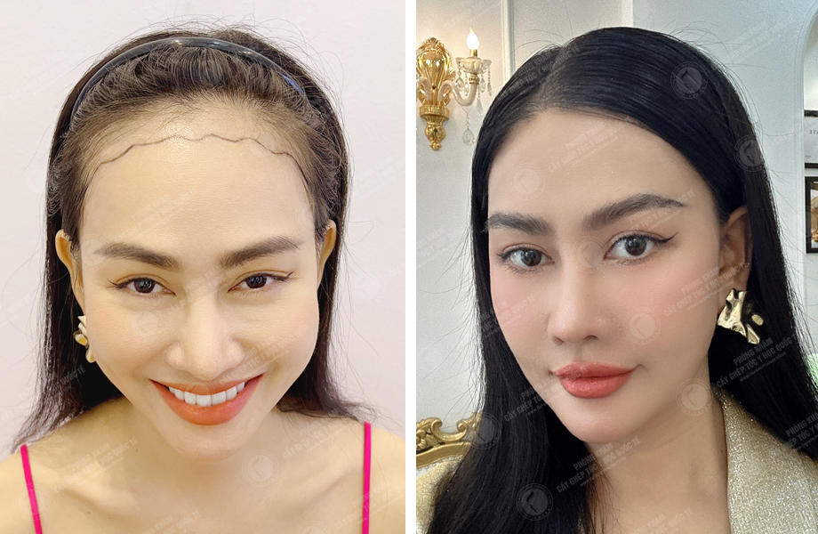  Á hậu Phạm Kim Duyên - Cấy tóc tự thân 1