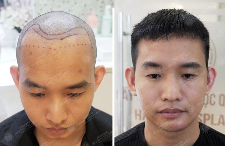  Lê Bá Hiệp - Cấy tóc tự thân 1