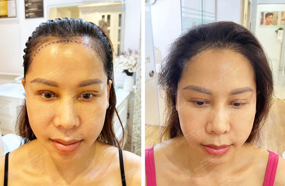  Ngô Thùy Dương - Cấy tóc tự thân 1