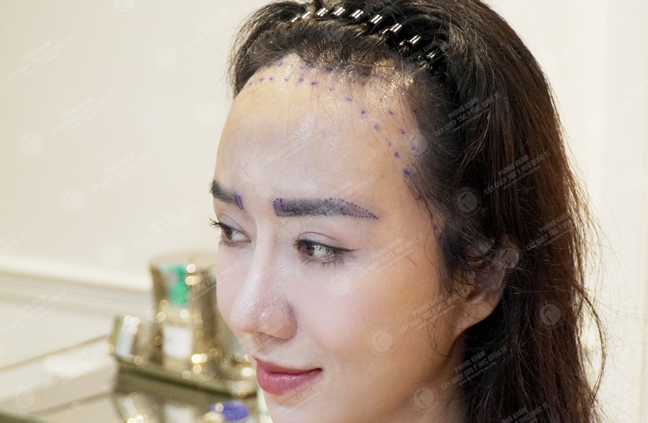 Nguyễn Thảo Phương - Cấy lông mày 4