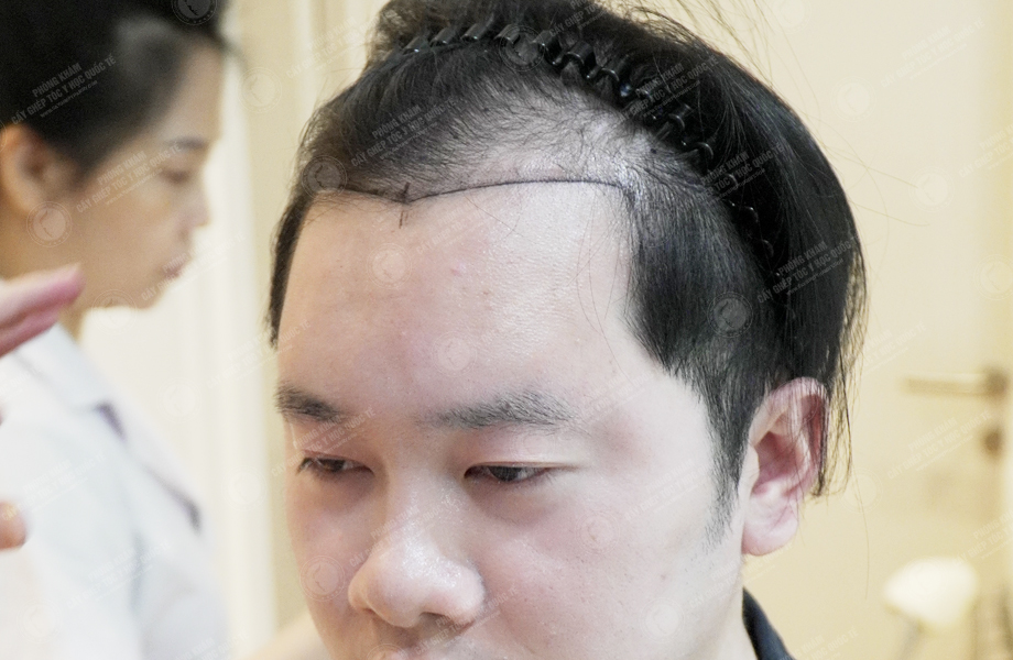 Nguyễn Thanh Tân - Cấy tóc đường chữ M 4