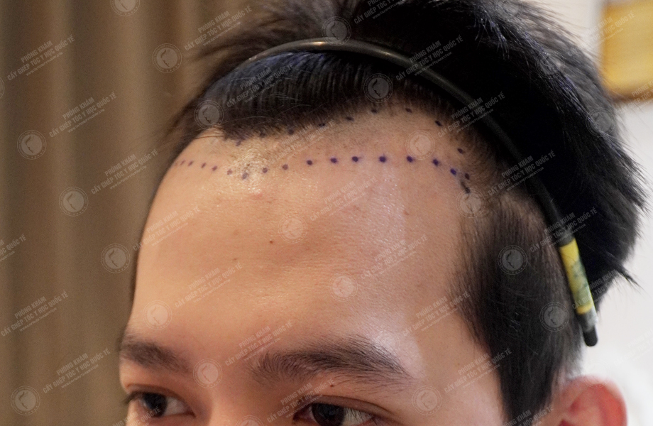 Nguyễn Thành Hưng - Cấy tóc đường chữ M 4