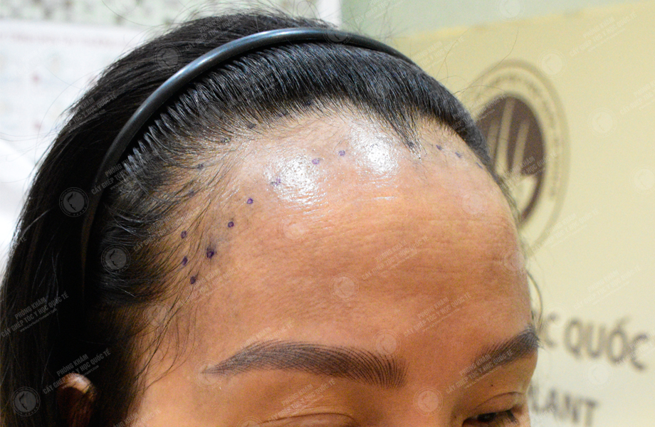 Phan Thị Tuyết - Cấy tóc đường chữ M 4