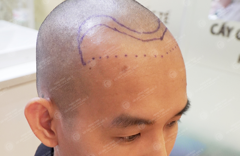 Lê Bá Hiệp - Cấy tóc đường chữ M 4