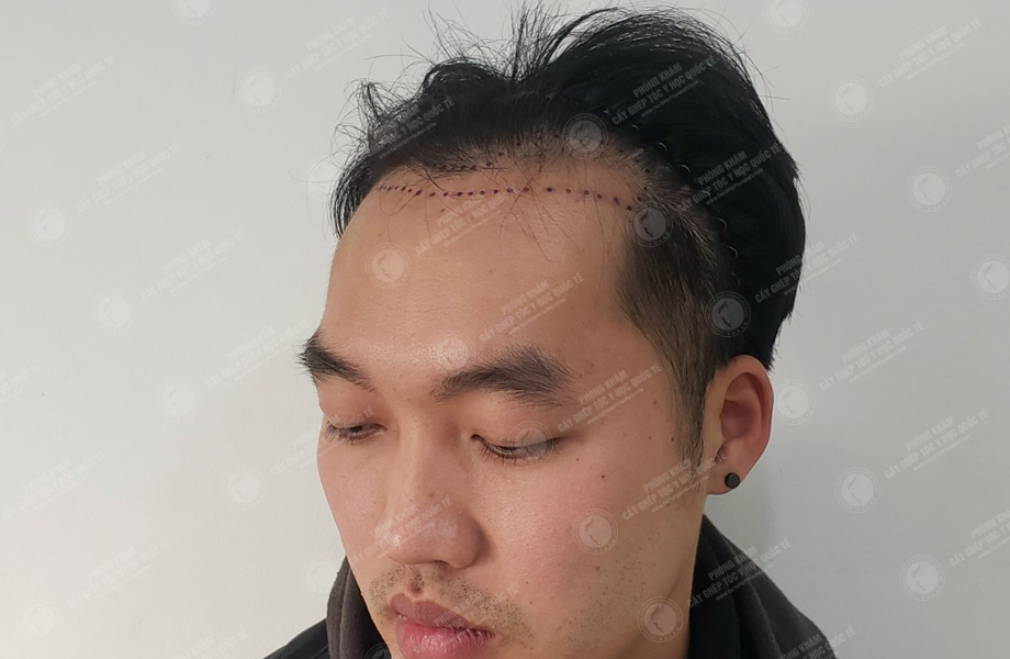Phạm Trung Tuấn - Cấy tóc đường chữ M 4