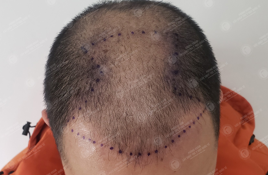 Trần Duy Tâm - Cấy tóc đường chữ M 4
