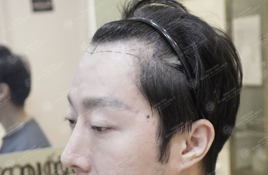 Hà Hoàng Phước - Cấy tóc đường chữ M 4