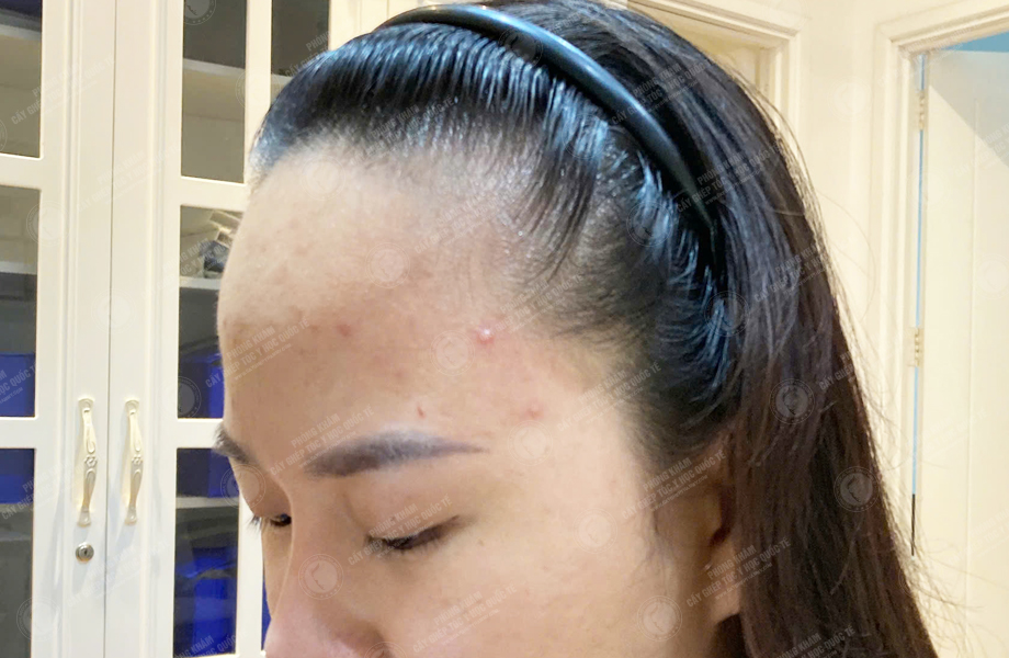 Nguyễn Thị Thúy Hằng - Cấy tóc đường chữ M 4