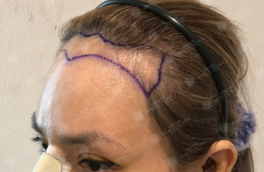 Lê Nhi - Cấy tóc đường chữ M 4