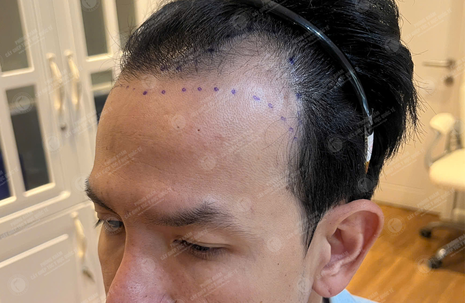 Nguyễn Hoàng Long - Cấy tóc đường chữ M 4