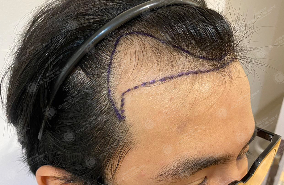 Hoàng Thanh Sơn - Cấy tóc đường chữ M 4