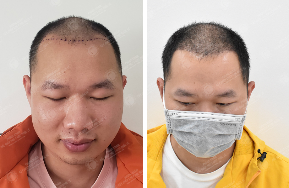  Trần Duy Tâm - Cấy tóc đường chữ M 1