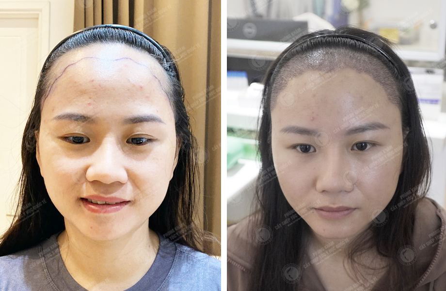  Nguyễn Thị Thúy Hằng - Cấy tóc tự thân 1
