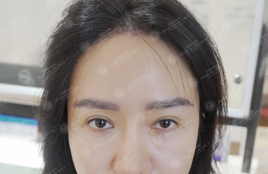 Nguyễn Thảo Phương - Cấy lông mày 5