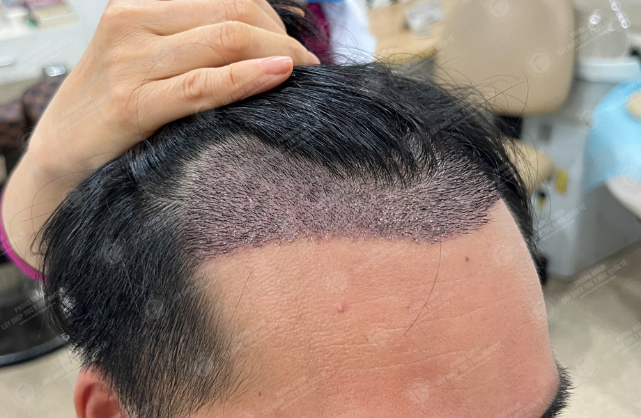 Phạm Trung Tuấn - Cấy tóc đường chữ M 5