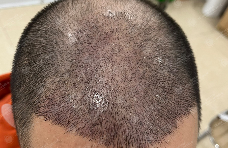 Trần Duy Tâm - Cấy tóc đường chữ M 5